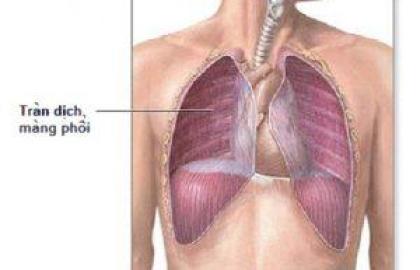 How to effectively support the treatment of pleural effusion with oriental medicine